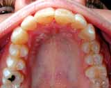 invisilgn clear lake texas,invisilign webster texas,invisilgn league city texas,braces clear lake texas,braces webster texas,braces league city texas